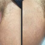 HA FILLERS TO PENIS FIRST TREATMENT