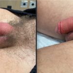 HA FILLERS TO PENIS FIRST TREATMENT