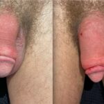 HA FILLERS TO PENIS SECOND TREATMENT
