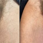 HA FILLERS TO PENIS THIRD TREATMENT