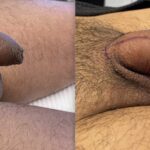 Male enhancement penile filler before and after penis enlargement results 125