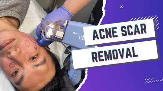 acne-scar-removal