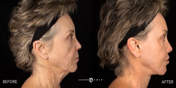 Improve Chest Wrinkles - Cosmetic Dermatologist Dr. Jason Emer