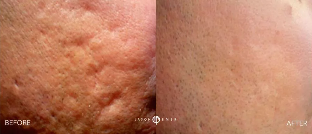 TREATING ACNE SCARS WITH RF MICRONEEDLING AND DERMAL FILLERS