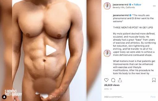 HD Liposculpture for Men