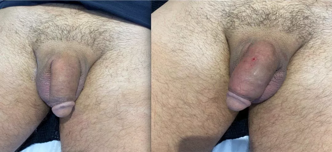 240215-1of3-1080x494 Penile Fat Injection