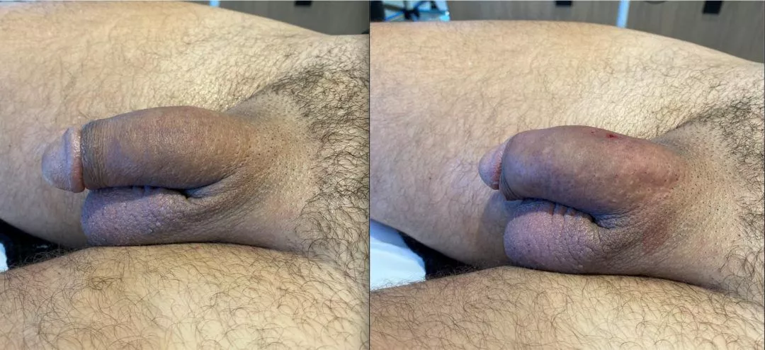 240215-2of3-1080x494 Penile Fat Transfer