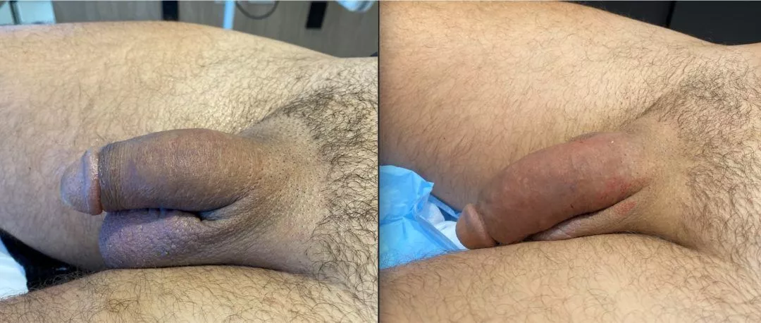 240220-2of3-1080x458 Penile Fat Injection