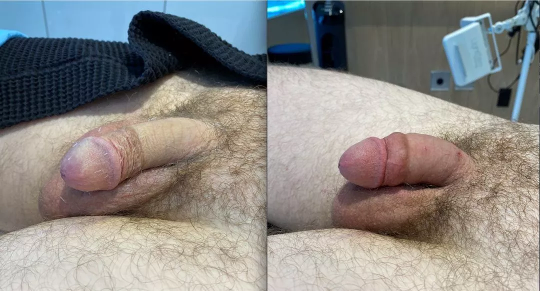 240250-2of3-1080x582 Penile Fat Injection
