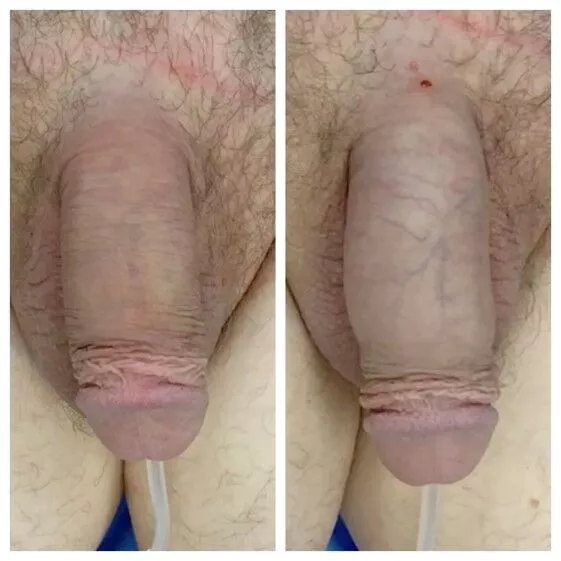 240285-1of2 Penile Fat Transfer