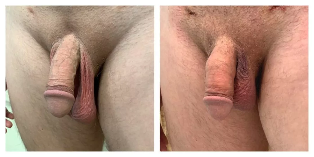 240290-2of3-1080x540 Penile Fat Transfer