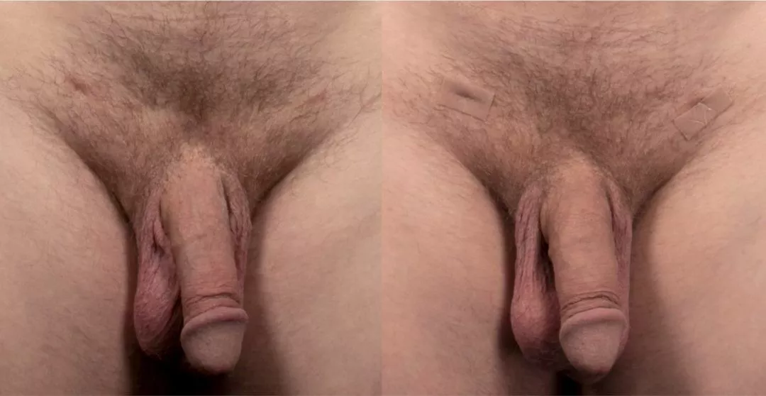 240294-1of2-1080x558 Penile Fat Transfer