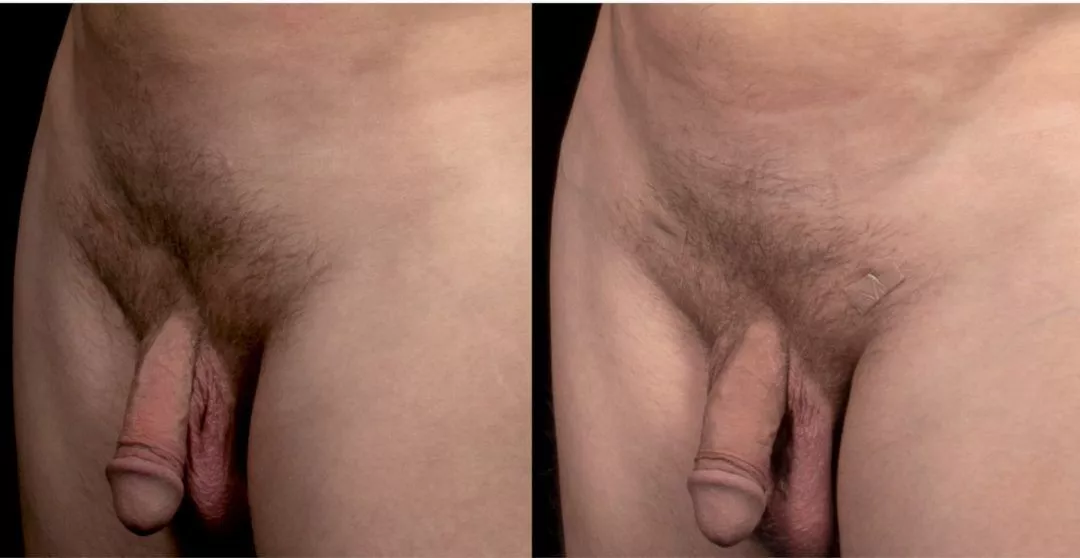 240294-2of2-1080x558 Penile Fat Transfer