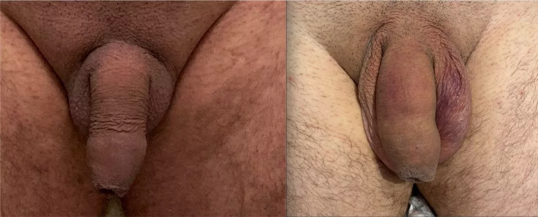 240297-2of2-1080x435 Penile Fat Transfer