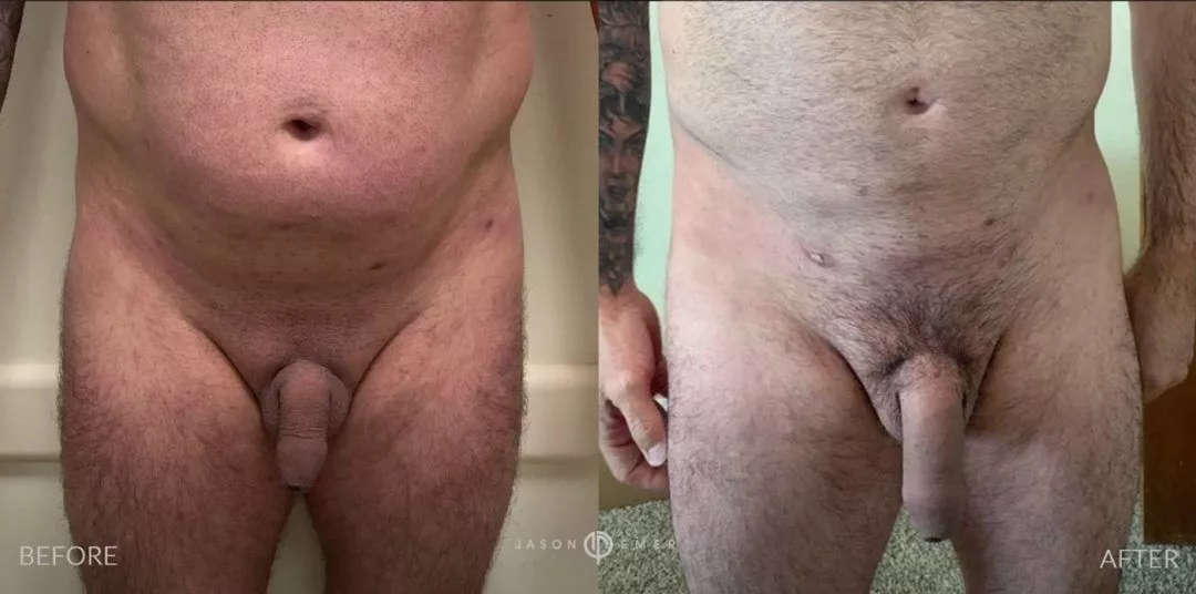 240307-1of2-1080x536 Penile Fat Transfer
