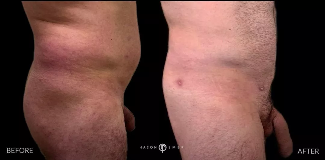240307-2of2-1080x532 Penile Fat Transfer