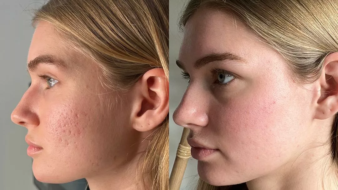 Acne-bxa2-1080x608