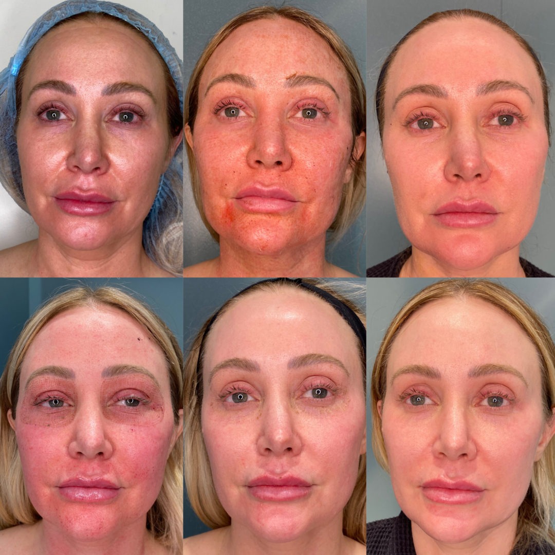 Facial-Sculpting-1080x1080