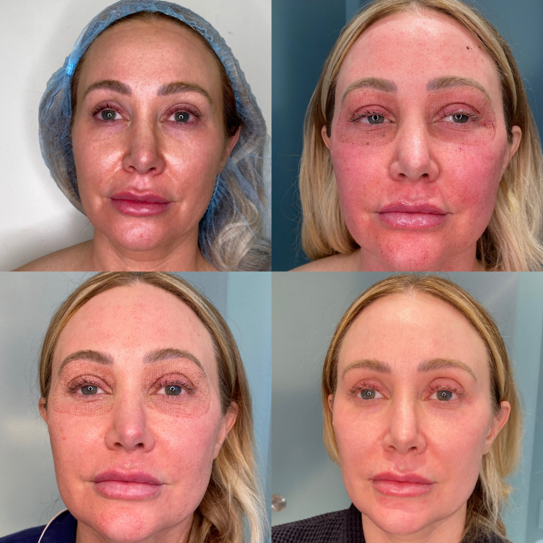 Facial-Sculpting-Before-and-After-1080x1080