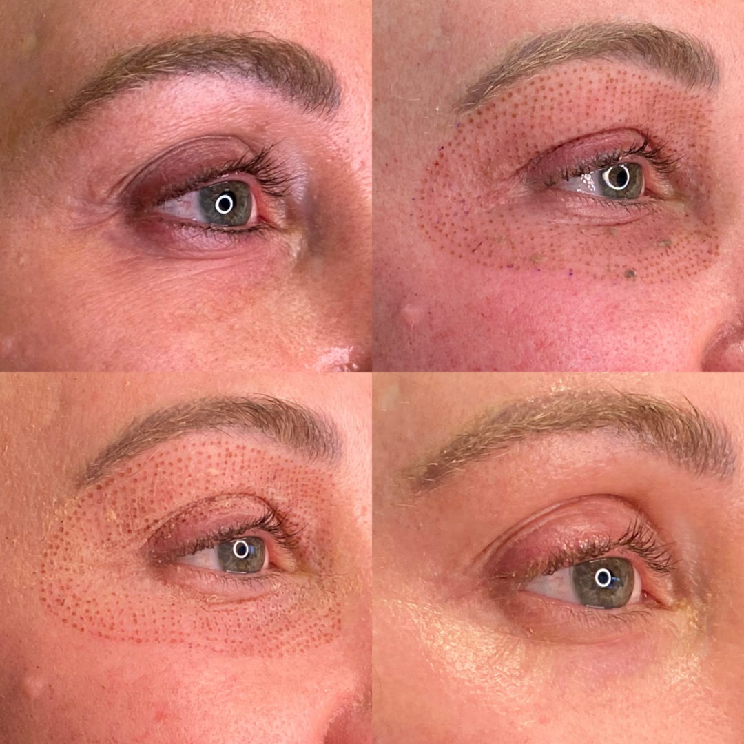Facial-Sculpting-Eye-Rejuvenation-1080x1080