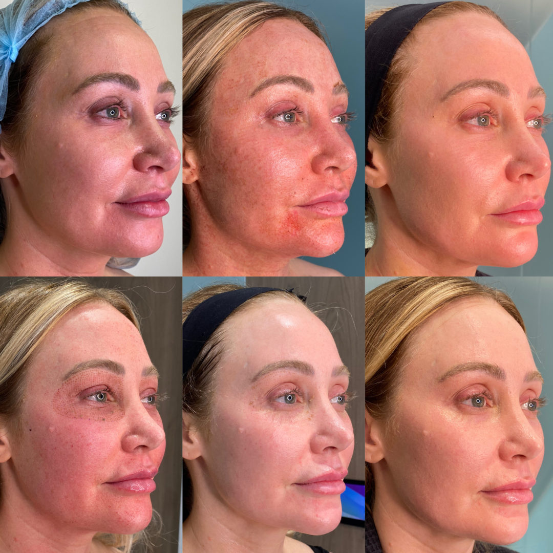 Facial-Sculpting-Side-Profile-1080x1080