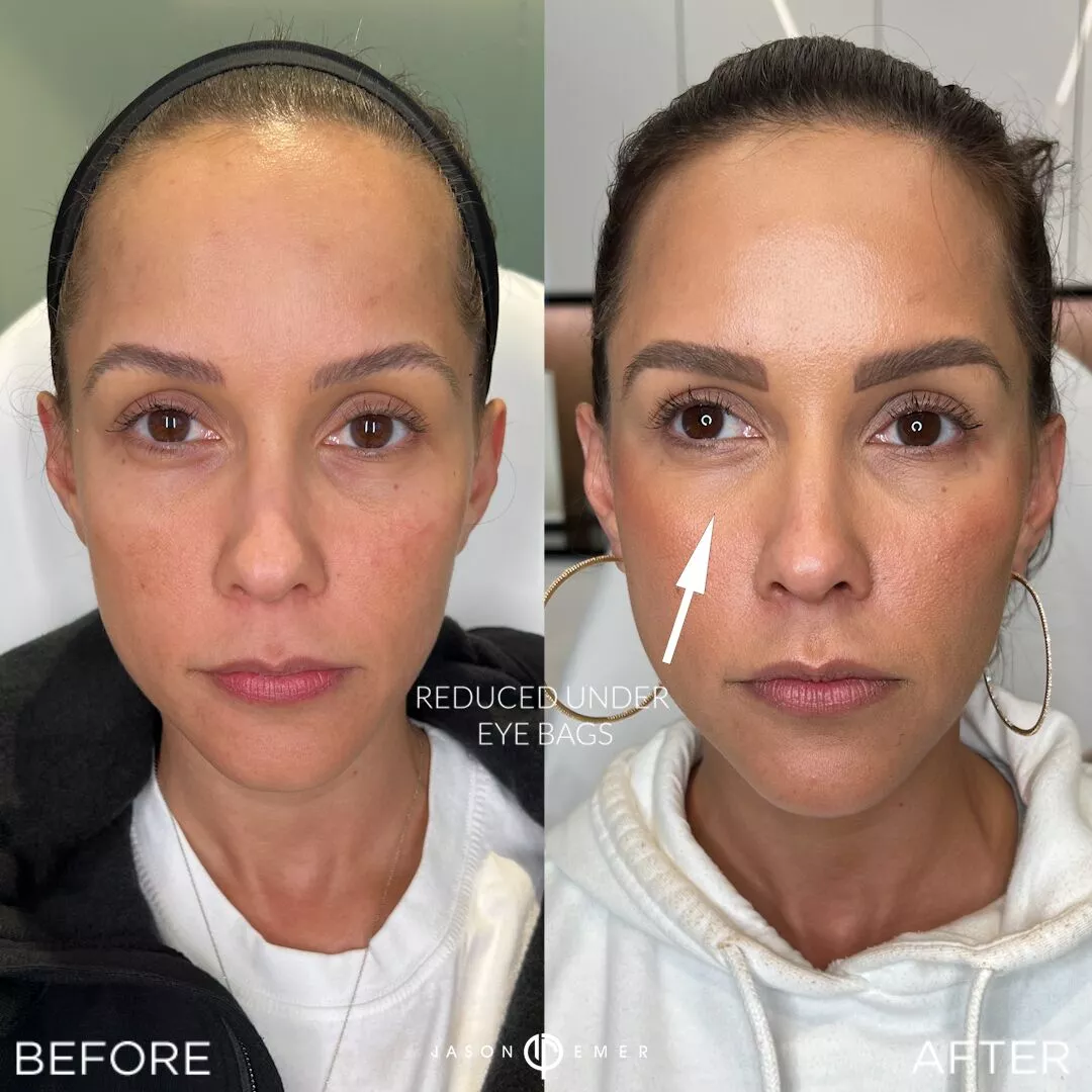 female-facial-sculpting-bxa-1