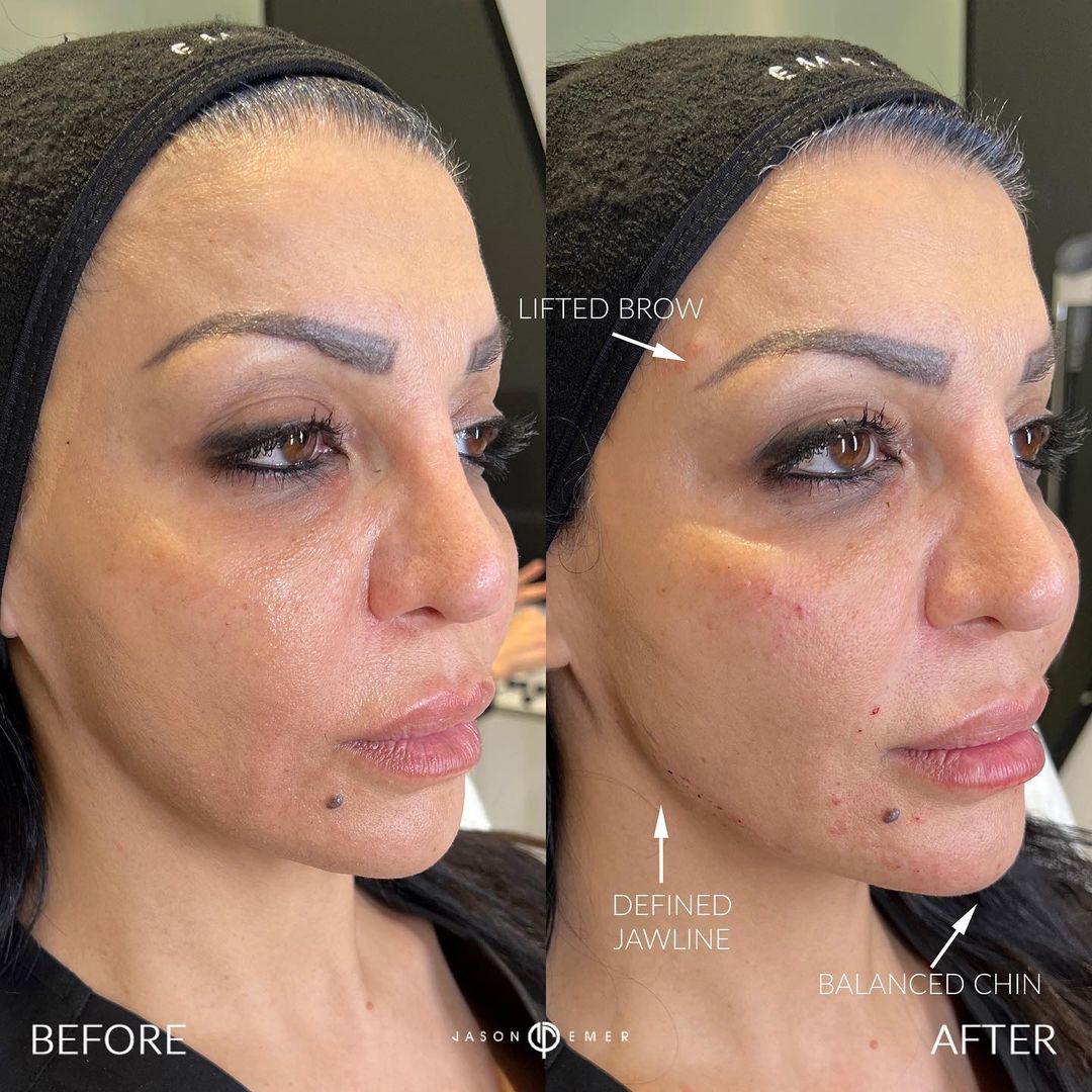 fillers-bxa